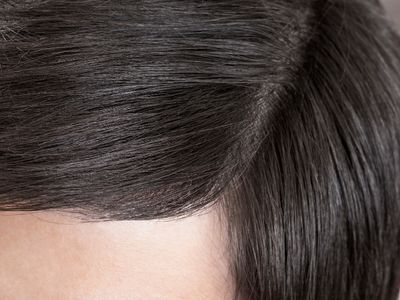 TRAPIANTO DI CAPELLI